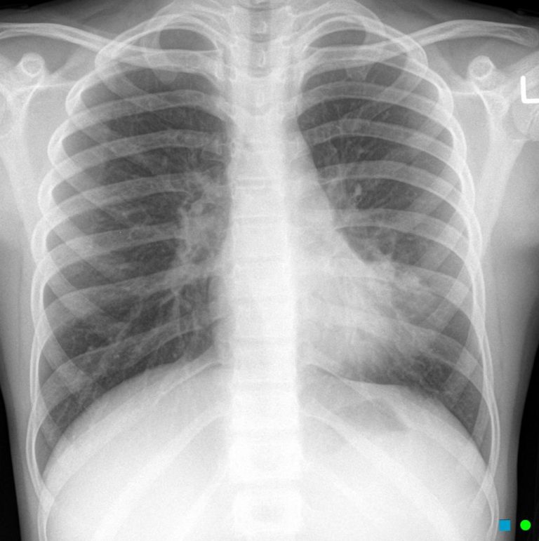 001 lul lingular pneumonia 2 emergency medicine png